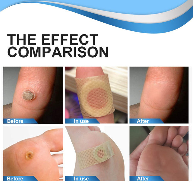 Aliver Wart Remover Strips for Foot Care Cleaning anti Pruritus and Antibacterial 24 Pcs