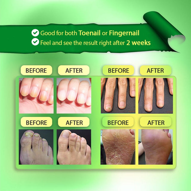 Golden Nutrition Nail Fungus Treatment, Nail Repair Solution
