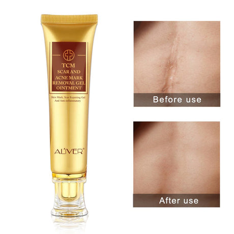 Aliver 2 Pack TCM Scar Acne Mark Removal Gel Anti-Inflammatory
